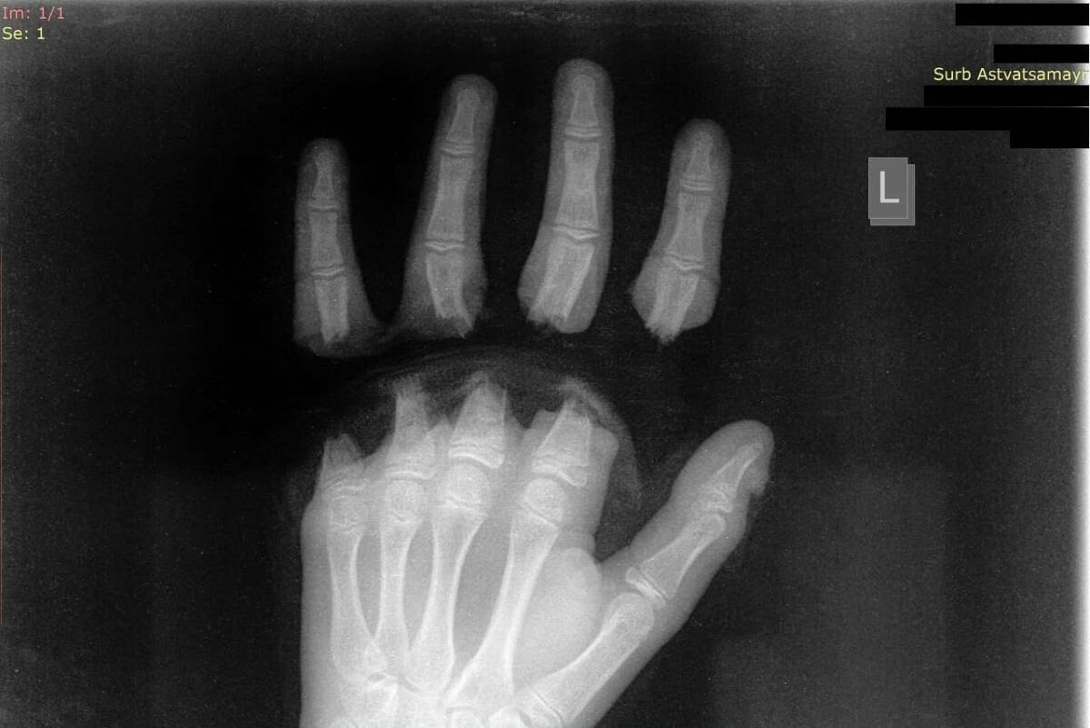 «Սուրբ Աստվածամայր» ԲԿ է ընդունվել 12 տարեկան երեխա՝ ձեռքի չորս մատների ամպուտացմամբ